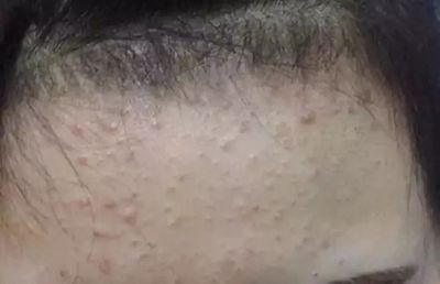 閉合性粉刺的預防和護理